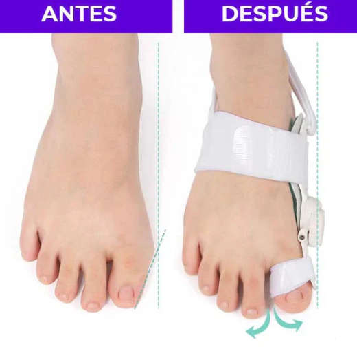CORRECTOR DE JUANETES ELIMINA DOLOR EN PIES